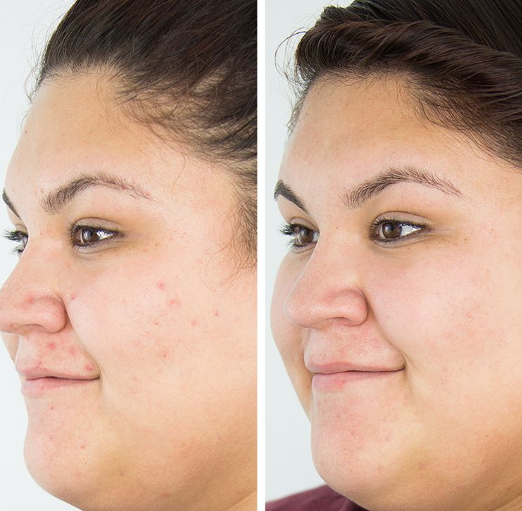 Clear 1 Acne Cleansing Bar in a Jar