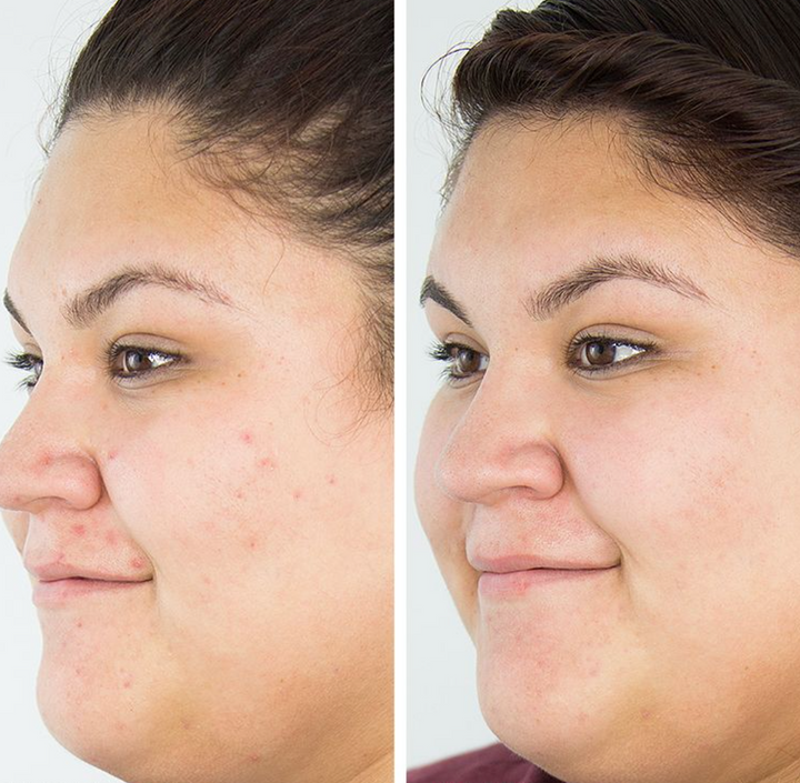 Clear 1 Acne Cleansing Bar in a Jar