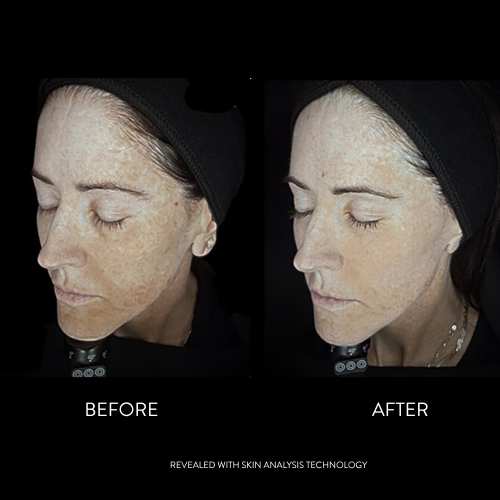 Brightening Bar